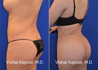 Patient 04 Left Side View Brazilian Butt Lift Beverly Hills Cosmetic Plastic Surgery Doc