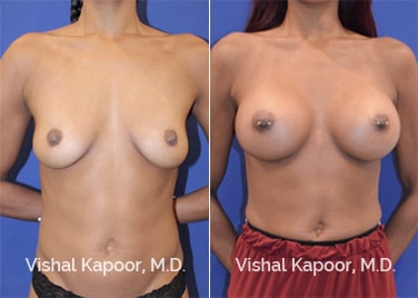 Patient 86 Front View Breast Augmentation Beverly Hills Cosmetic Plastic Surgery Doc