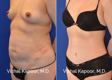 Tummy Tuck performed in Beverly Hills by Dr Vishal Kapoor