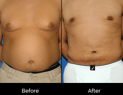 Male Liposuction Beverly Hills