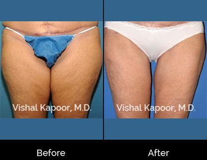 Thigh Liposuction Beverly Hills